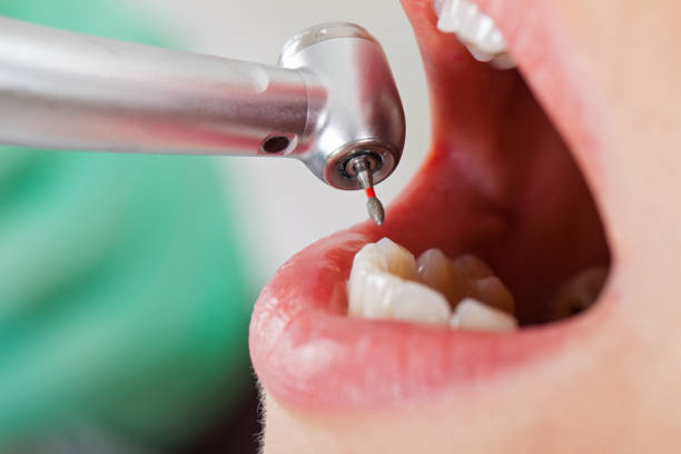 Best Emergency Dental Care for Broken or Chipped Teeth in Wareham Center, MA